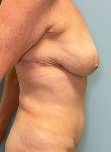 Liposuction After Photo by Julia Spears, MD, FACS; ,  - Case 50380