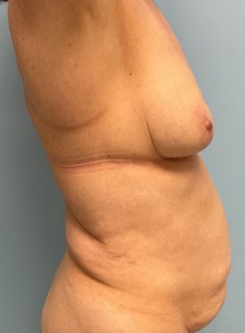 Liposuction Before Photo by Julia Spears, MD, FACS; ,  - Case 50380