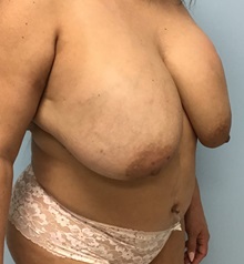 Liposuction Before Photo by Julia Spears, MD, FACS; ,  - Case 50388