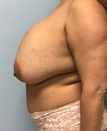 Liposuction Before Photo by Julia Spears, MD, FACS; ,  - Case 50388