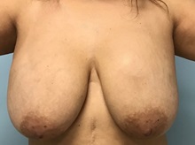 Breast Implant Removal Before Photo by Julia Spears, MD, FACS; ,  - Case 50387