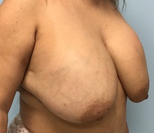 Breast Implant Removal Before Photo by Julia Spears, MD, FACS; ,  - Case 50387