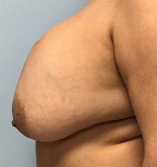 Breast Implant Removal Before Photo by Julia Spears, MD, FACS; ,  - Case 50387
