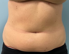 Liposuction Before Photo by Julia Spears, MD, FACS; ,  - Case 50420
