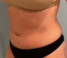 Liposuction After Photo by Julia Spears, MD, FACS; ,  - Case 50420
