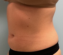 Liposuction Before Photo by Julia Spears, MD, FACS; ,  - Case 50420