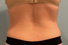 Liposuction After Photo by Julia Spears, MD, FACS; ,  - Case 50420