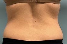Liposuction Before Photo by Julia Spears, MD, FACS; ,  - Case 50420