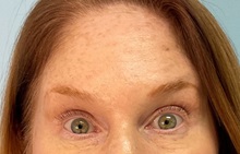 Botulinum Toxin After Photo by Julia Spears, MD, FACS; ,  - Case 50421