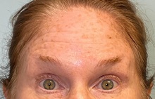 Botulinum Toxin Before Photo by Julia Spears, MD, FACS; ,  - Case 50421