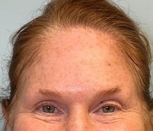 Botulinum Toxin Before Photo by Julia Spears, MD, FACS; ,  - Case 50421