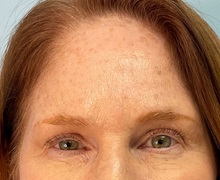 Botulinum Toxin After Photo by Julia Spears, MD, FACS; ,  - Case 50421