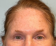 Botulinum Toxin Before Photo by Julia Spears, MD, FACS; ,  - Case 50421