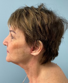 Facelift After Photo by Julia Spears, MD, FACS; ,  - Case 50425