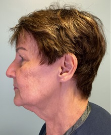 Facelift Before Photo by Julia Spears, MD, FACS; ,  - Case 50425