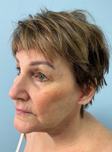 Facelift After Photo by Julia Spears, MD, FACS; ,  - Case 50425