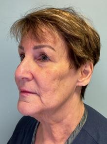 Facelift Before Photo by Julia Spears, MD, FACS; ,  - Case 50425
