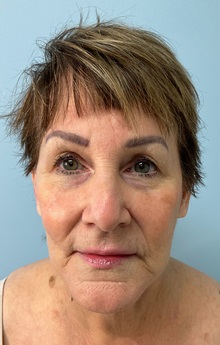Facelift After Photo by Julia Spears, MD, FACS; ,  - Case 50425