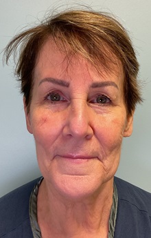 Facelift Before Photo by Julia Spears, MD, FACS; ,  - Case 50425
