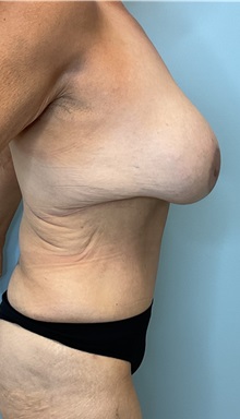 Tummy Tuck After Photo by Julia Spears, MD, FACS; ,  - Case 50426