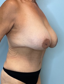 Tummy Tuck After Photo by Julia Spears, MD, FACS; ,  - Case 50426