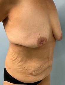 Tummy Tuck Before Photo by Julia Spears, MD, FACS; ,  - Case 50426