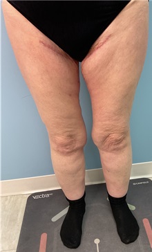 Liposuction After Photo by Julia Spears, MD, FACS; ,  - Case 50445