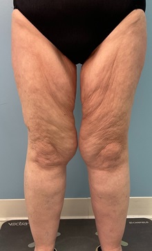 Liposuction Before Photo by Julia Spears, MD, FACS; ,  - Case 50445