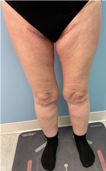 Thigh Lift After Photo by Julia Spears, MD, FACS; ,  - Case 50444