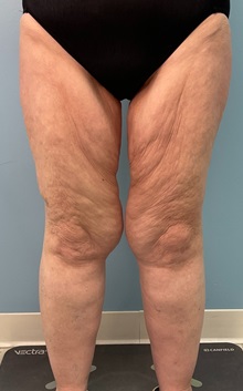 Thigh Lift Before Photo by Julia Spears, MD, FACS; ,  - Case 50444