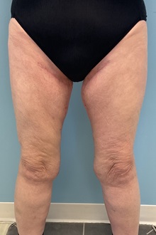 Thigh Lift After Photo by Julia Spears, MD, FACS; ,  - Case 50444