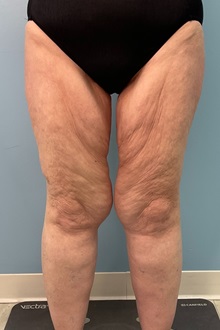 Thigh Lift Before Photo by Julia Spears, MD, FACS; ,  - Case 50444