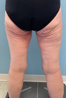 Thigh Lift After Photo by Julia Spears, MD, FACS; ,  - Case 50444
