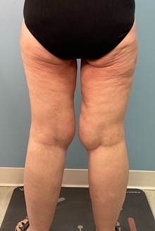 Thigh Lift Before Photo by Julia Spears, MD, FACS; ,  - Case 50444
