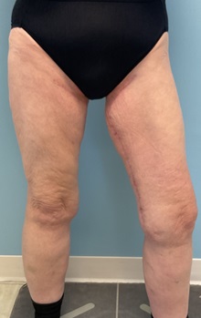 Thigh Lift After Photo by Julia Spears, MD, FACS; ,  - Case 50444