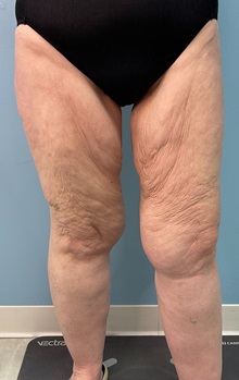 Thigh Lift Before Photo by Julia Spears, MD, FACS; ,  - Case 50444
