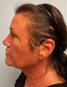 Facelift Before Photo by Julia Spears, MD, FACS; ,  - Case 50457