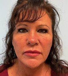 Facelift After Photo by Julia Spears, MD, FACS; ,  - Case 50457