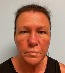 Facelift Before Photo by Julia Spears, MD, FACS; ,  - Case 50457