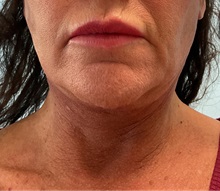 Neck Lift After Photo by Julia Spears, MD, FACS; ,  - Case 50458