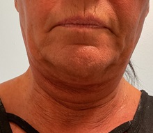 Neck Lift Before Photo by Julia Spears, MD, FACS; ,  - Case 50458