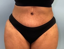 Tummy Tuck After Photo by Julia Spears, MD, FACS; ,  - Case 50535