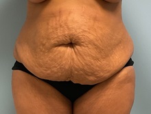 Tummy Tuck Before Photo by Julia Spears, MD, FACS; ,  - Case 50535