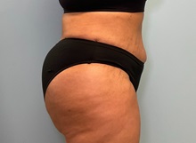 Tummy Tuck After Photo by Julia Spears, MD, FACS; ,  - Case 50535