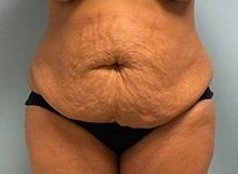 Liposuction Before Photo by Julia Spears, MD, FACS; ,  - Case 50536