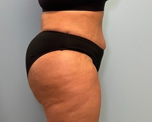 Liposuction After Photo by Julia Spears, MD, FACS; ,  - Case 50536