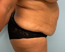 Liposuction Before Photo by Julia Spears, MD, FACS; ,  - Case 50536