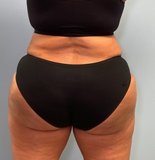 Liposuction After Photo by Julia Spears, MD, FACS; ,  - Case 50536
