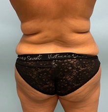 Liposuction Before Photo by Julia Spears, MD, FACS; ,  - Case 50536