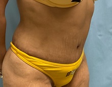 Tummy Tuck After Photo by Julia Spears, MD, FACS; ,  - Case 50538